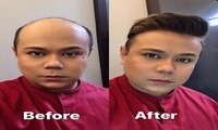 Best hair replacement in singapore